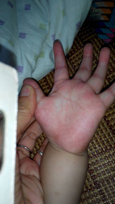 大三阳的症状有哪些