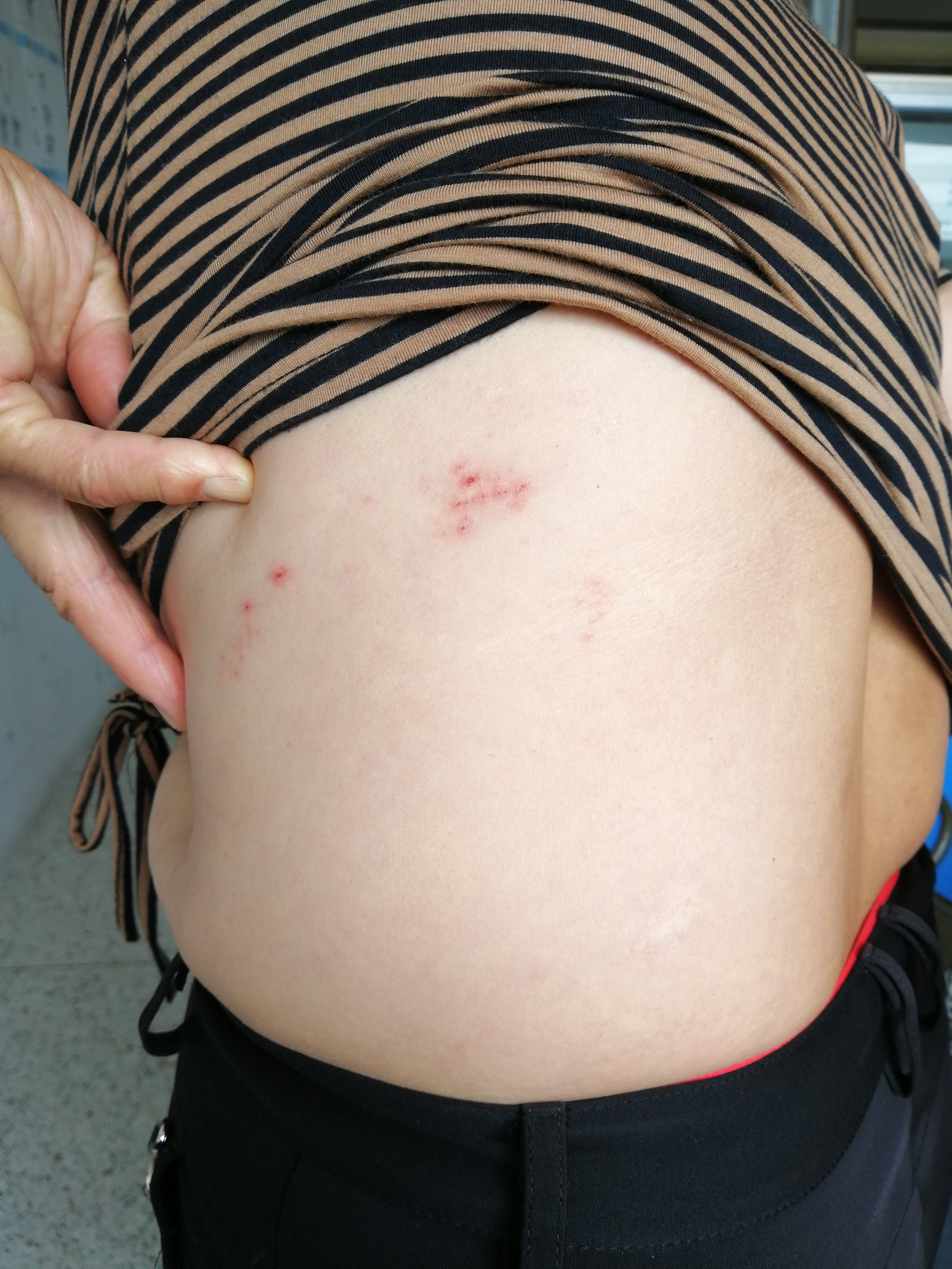 带状疱疹前期症状