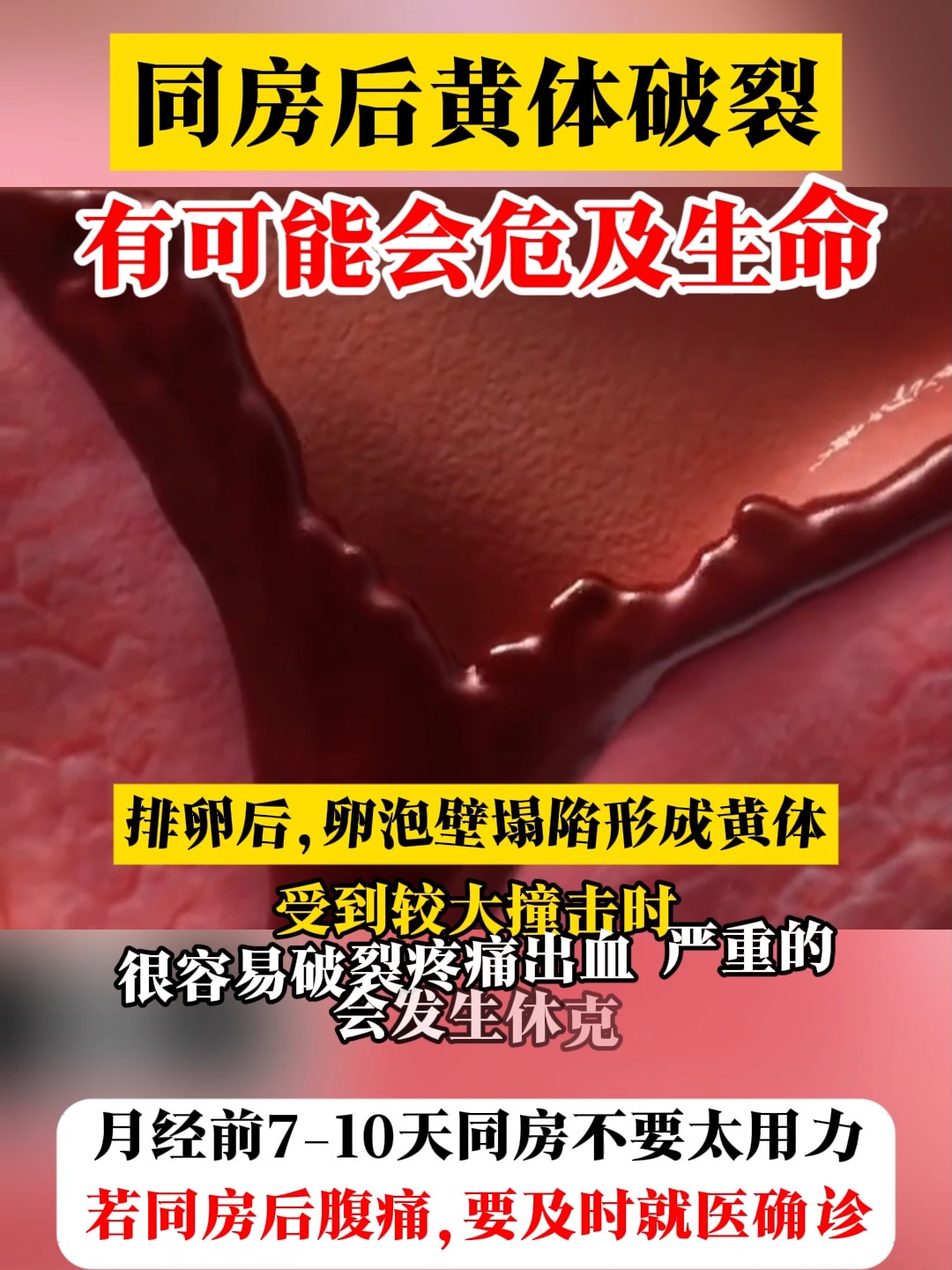 黄体破裂是什么原因造成的