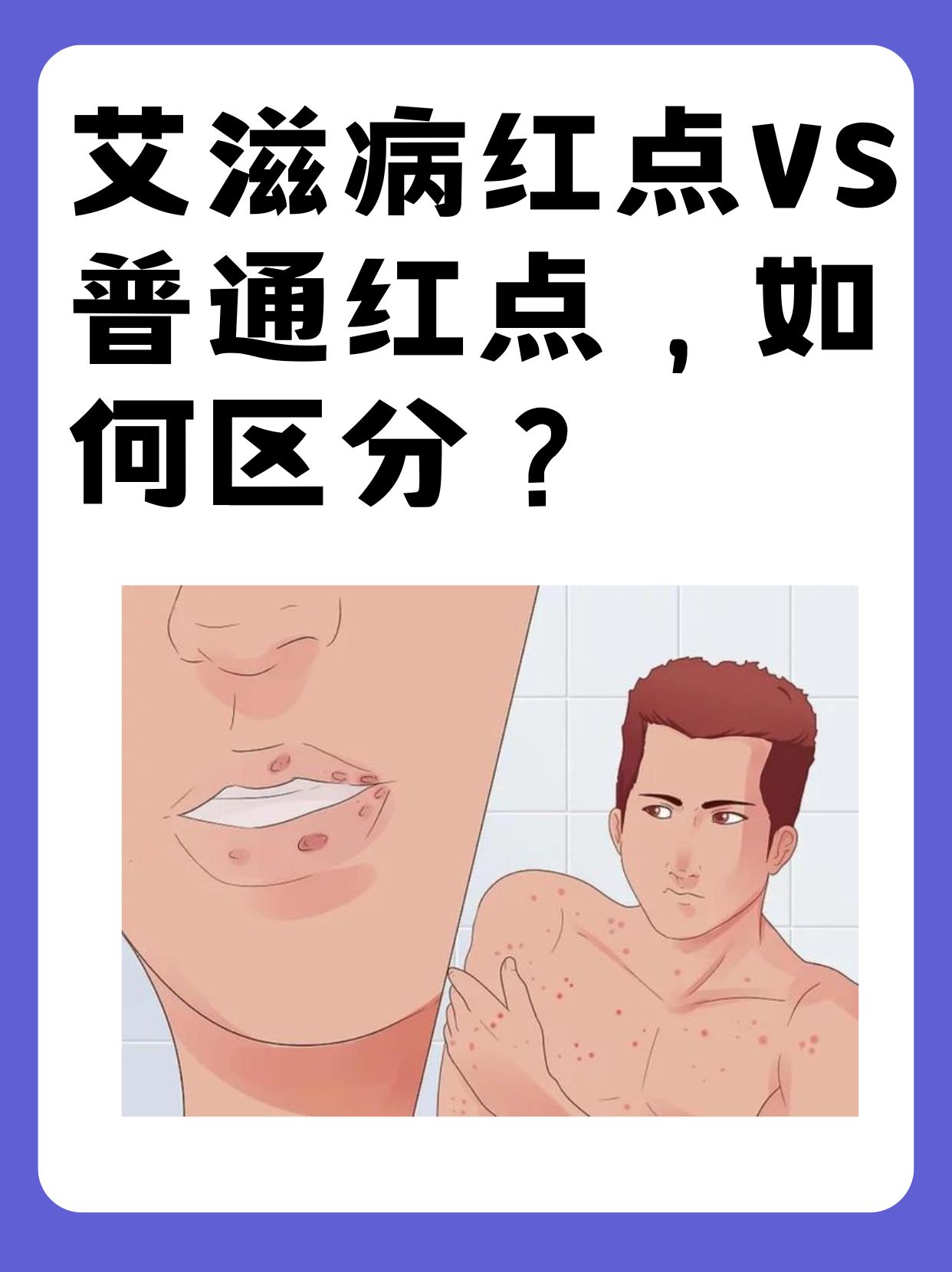 如何区分湿疹和艾滋病