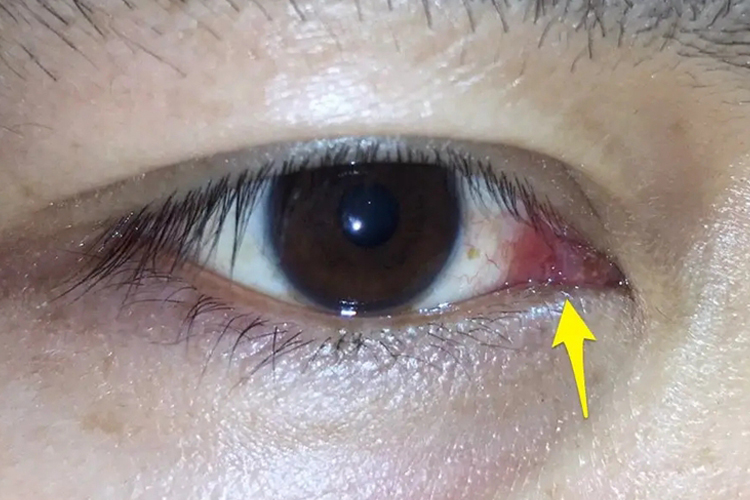 结膜炎的症状表现