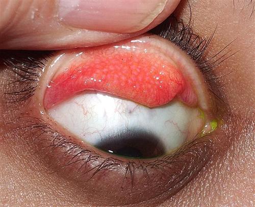 结膜炎的症状表现