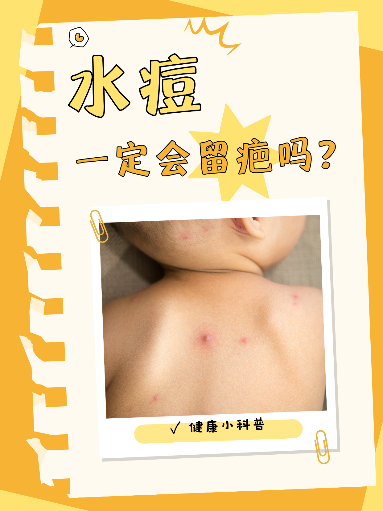 脓疱疮什么症状?和水痘有什么区别?