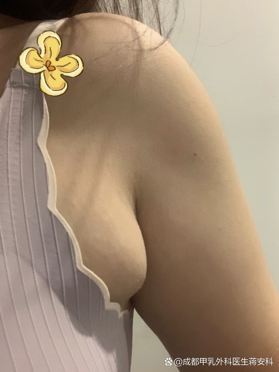 巨乳症是什么症状?