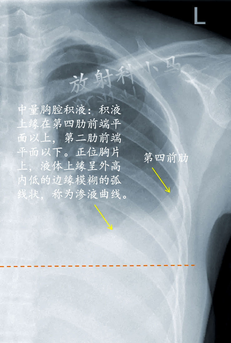 胸腔积液严重吗