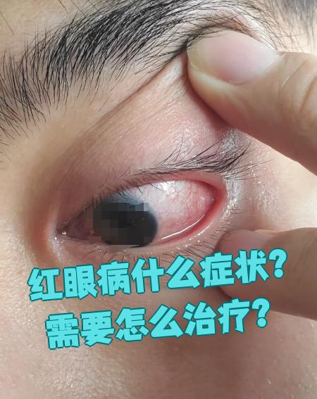 为什么会得红眼病???