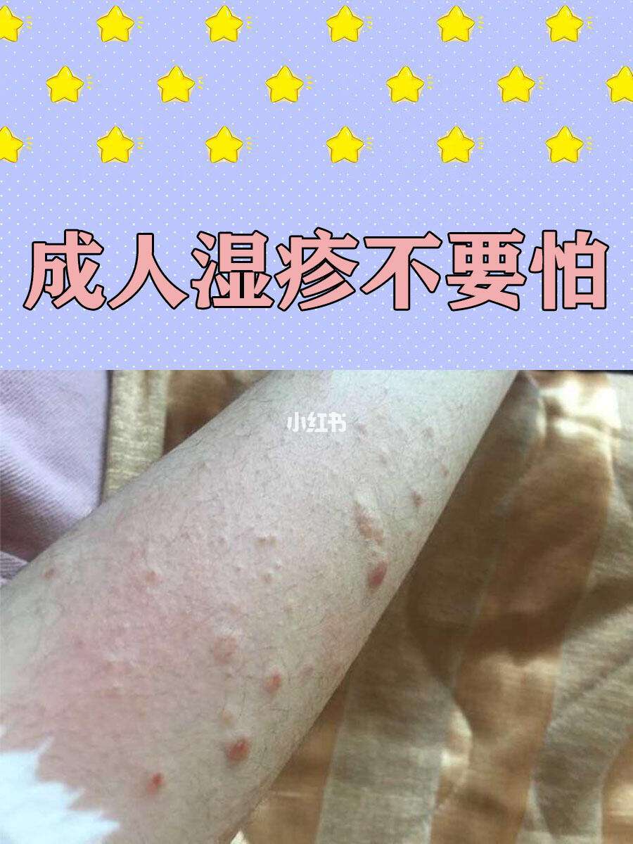 成人湿疹是怎么引起的