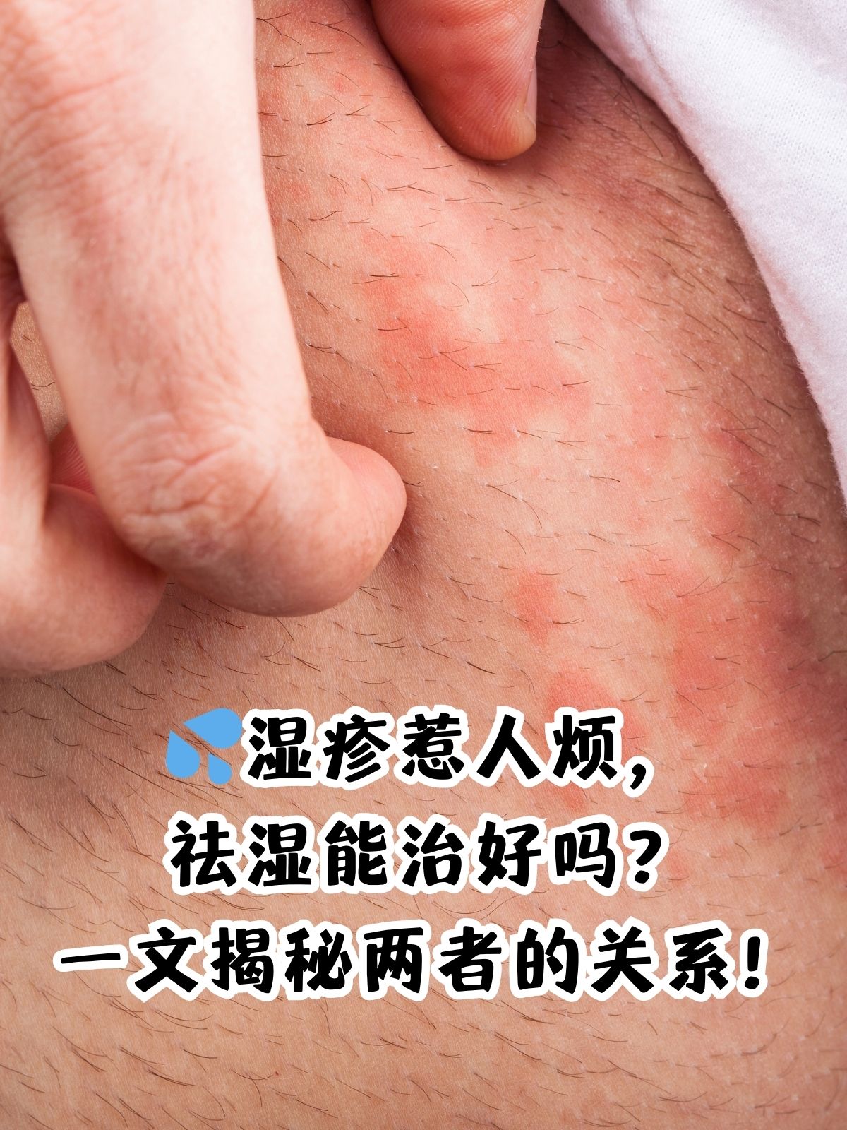 成人湿疹是怎么引起的