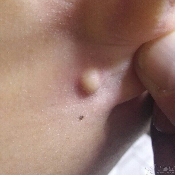 耳垂下面长了个硬疙瘩是什么