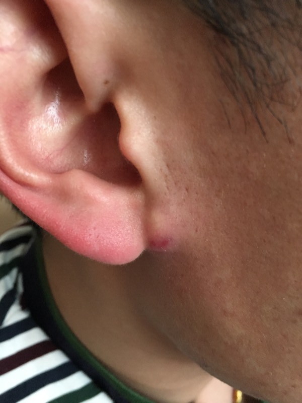 耳垂下面长了个硬疙瘩是什么