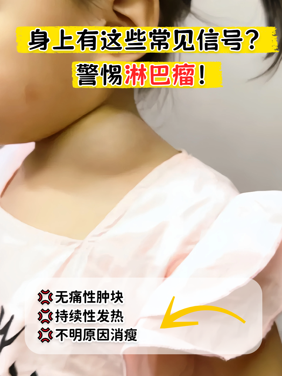 颈部淋巴瘤早期症状