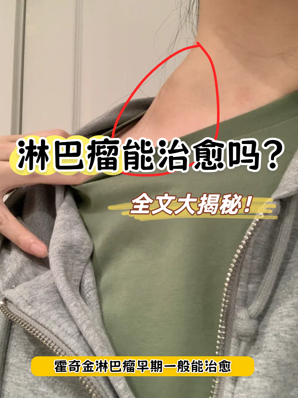 颈部淋巴瘤早期症状