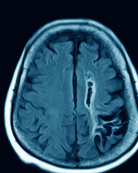 轻度脑萎缩能治好吗?