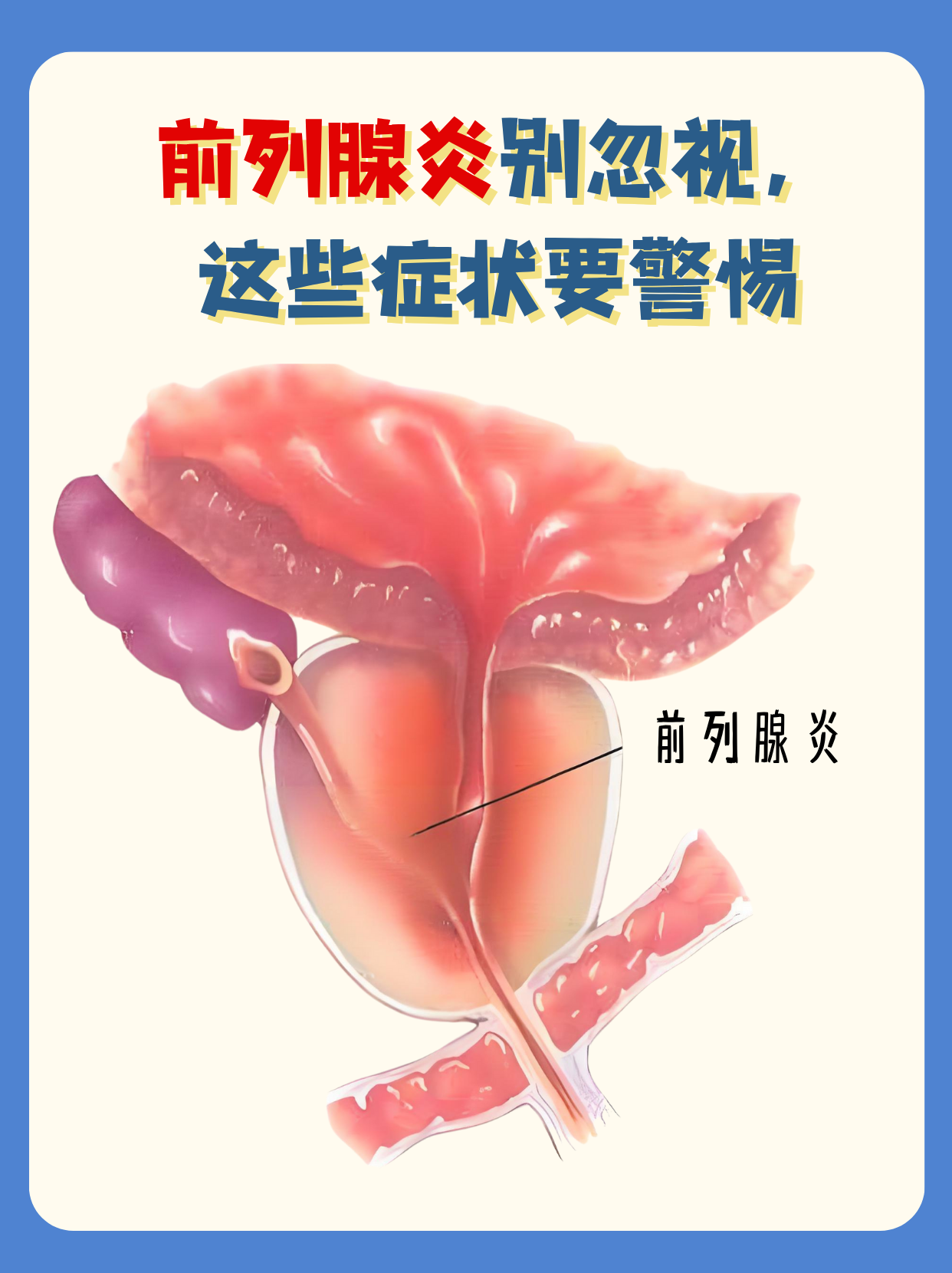 前列腺炎的症状是什么?