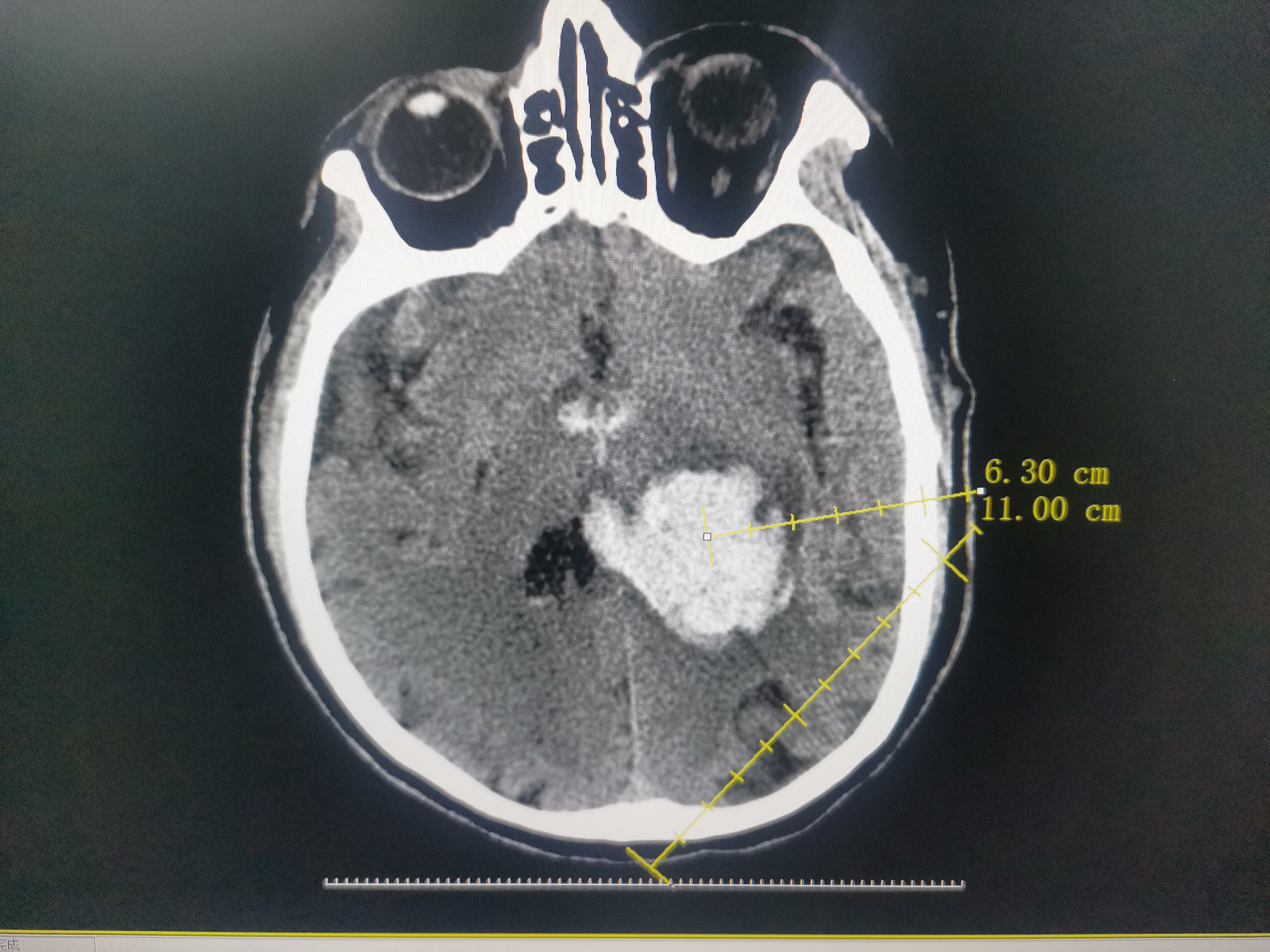 脑动脉瘤介入手术的后遗症有哪些