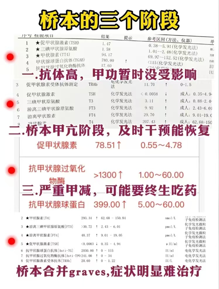 什么是桥本甲减