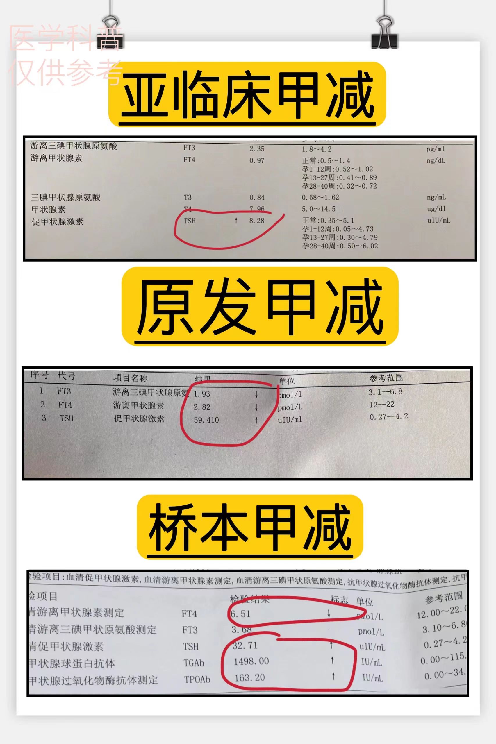 什么是桥本甲减