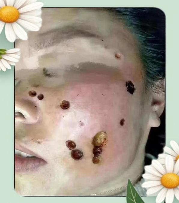 点痣后多久可以洗脸