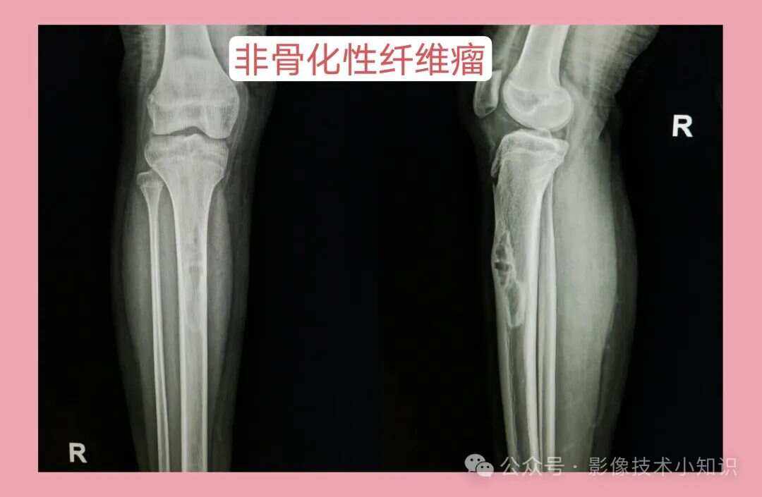 骨纤维结构不良的症状