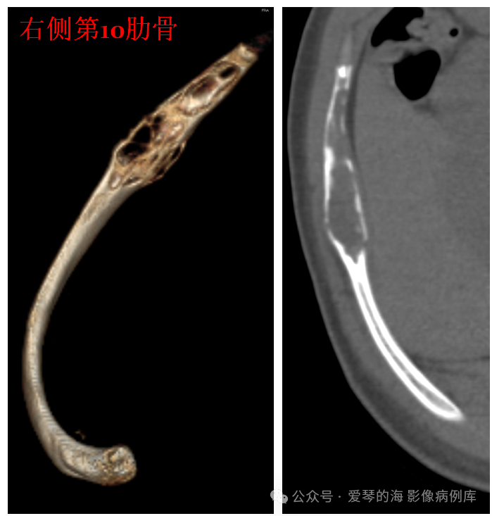骨纤维结构不良的症状