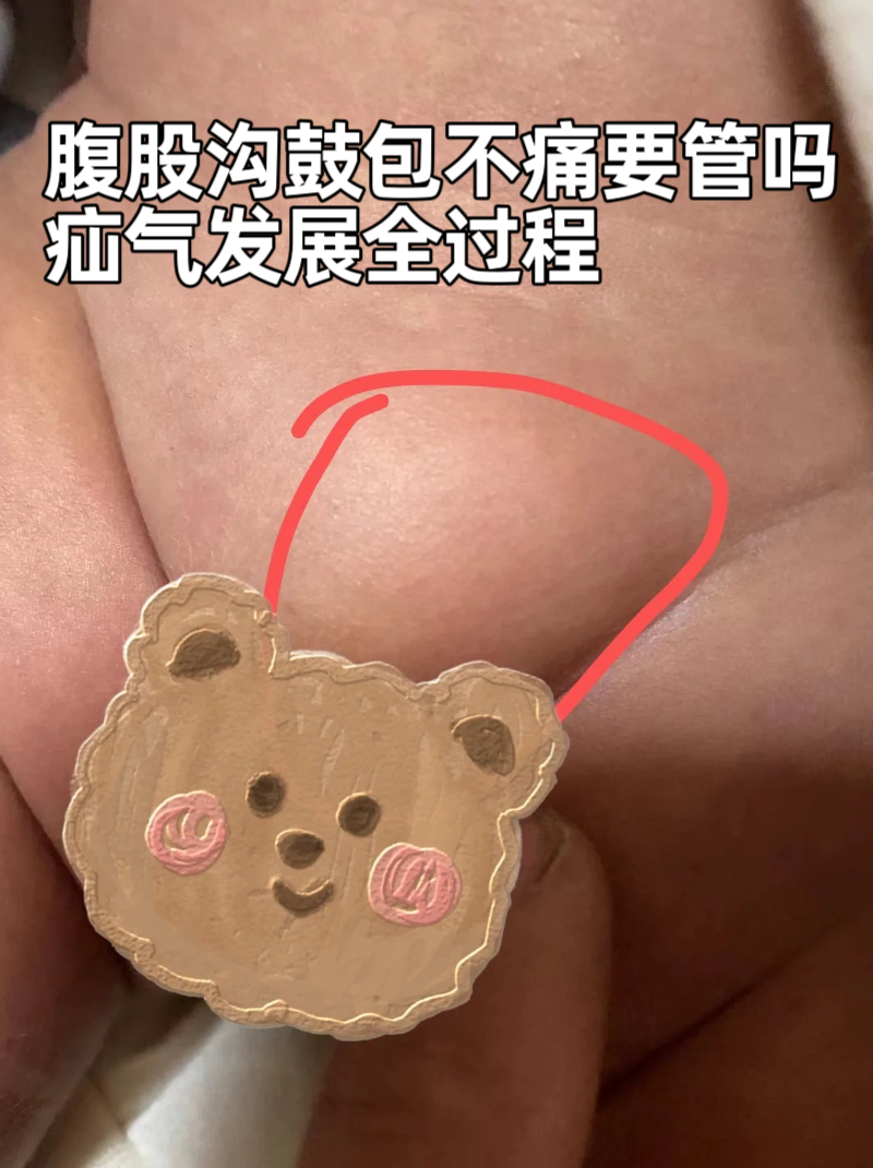 腹股沟疼是怎么回事?