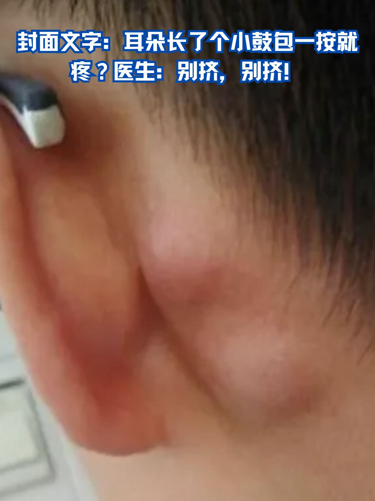 耳朵根长了个包,按压有点疼