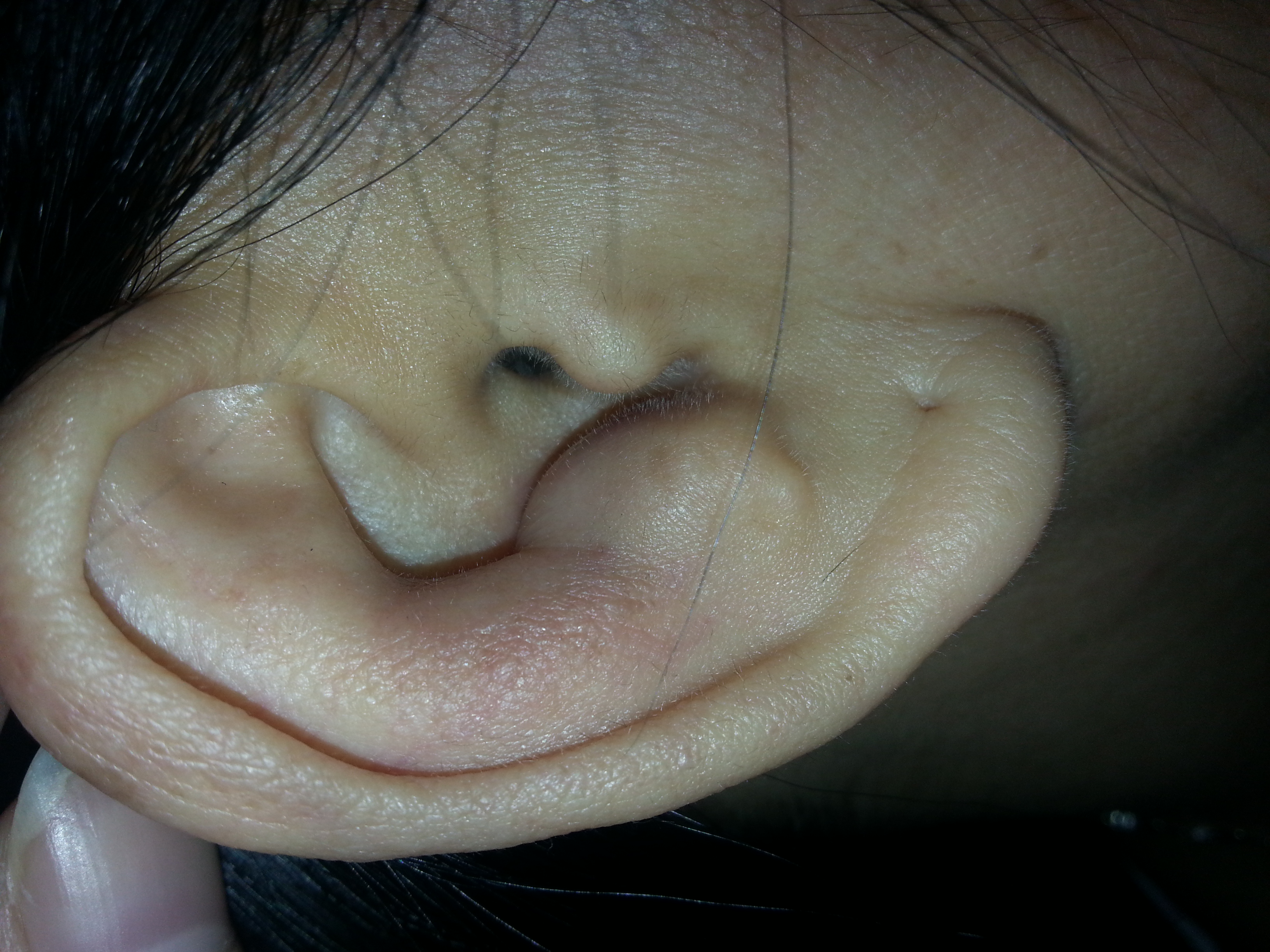 耳朵根长了个包,按压有点疼