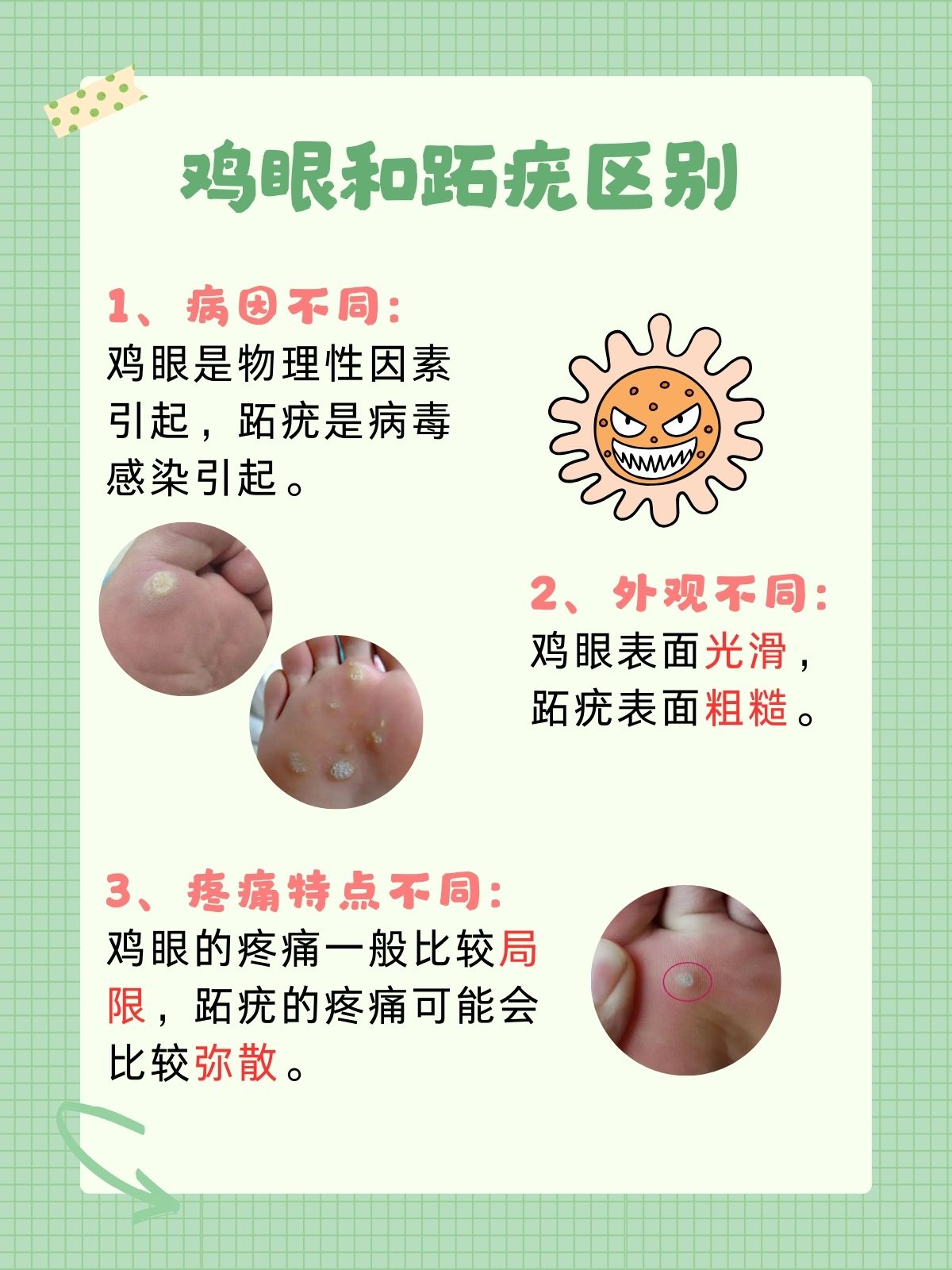 脚上长鸡眼怎么治?