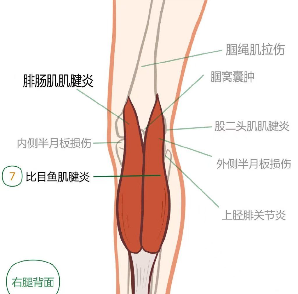 膝盖后面的腿窝筋痛怎么办