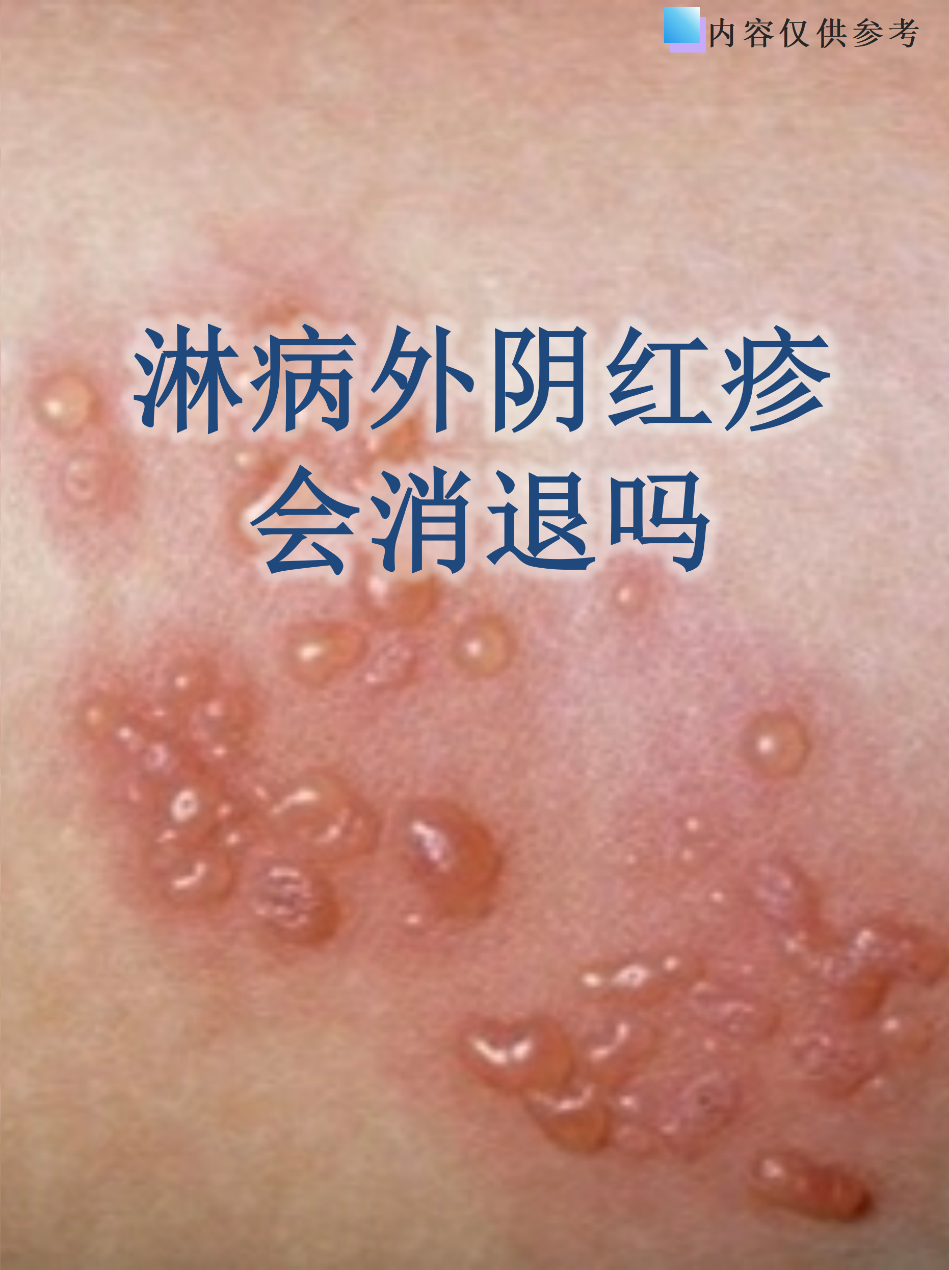 男性淋病的症状是什么