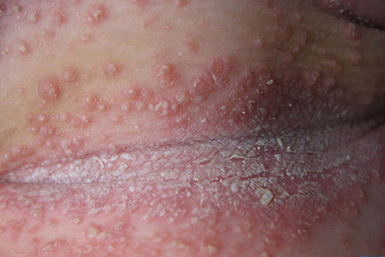 男性淋病的症状是什么