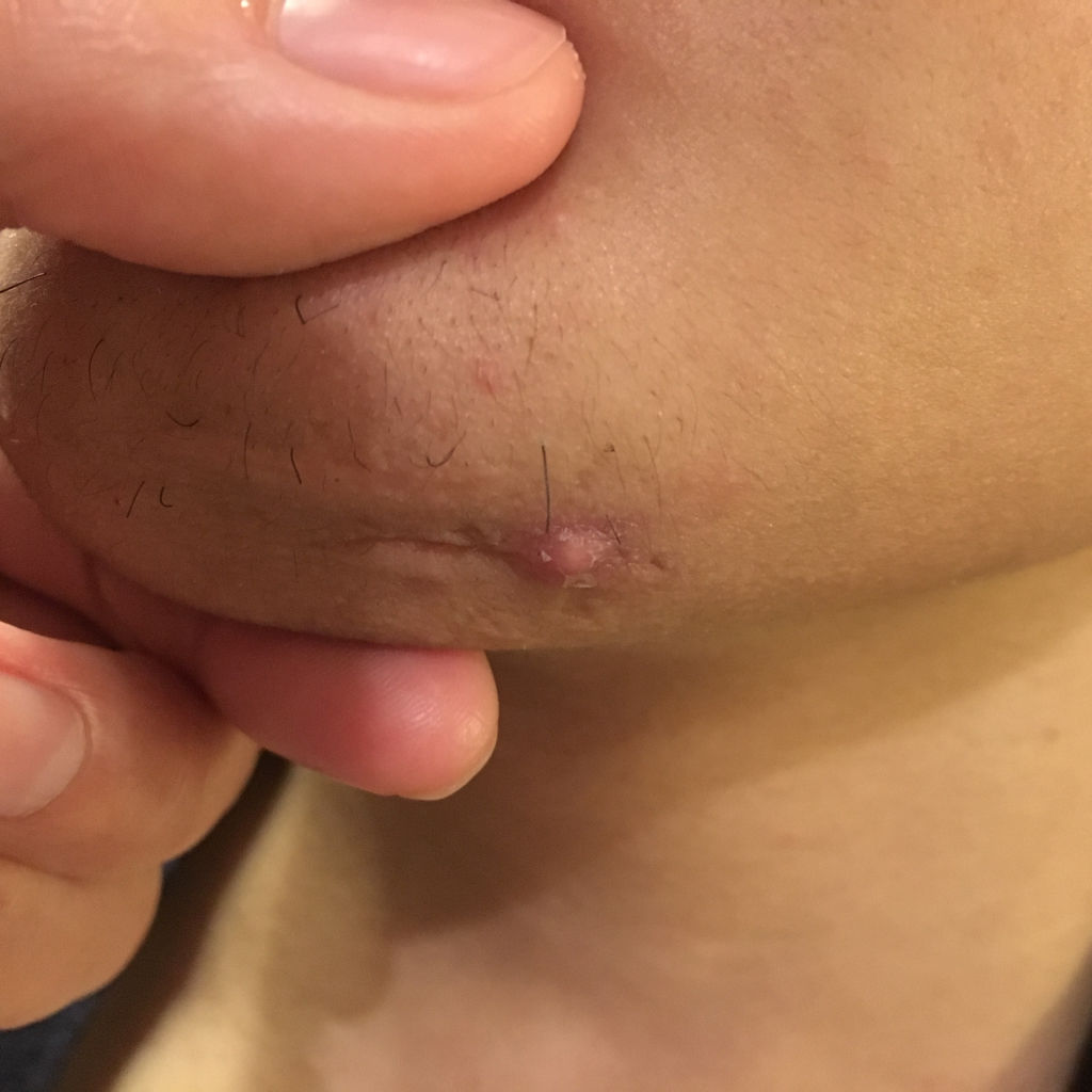 下巴长了个硬包,按压很痛