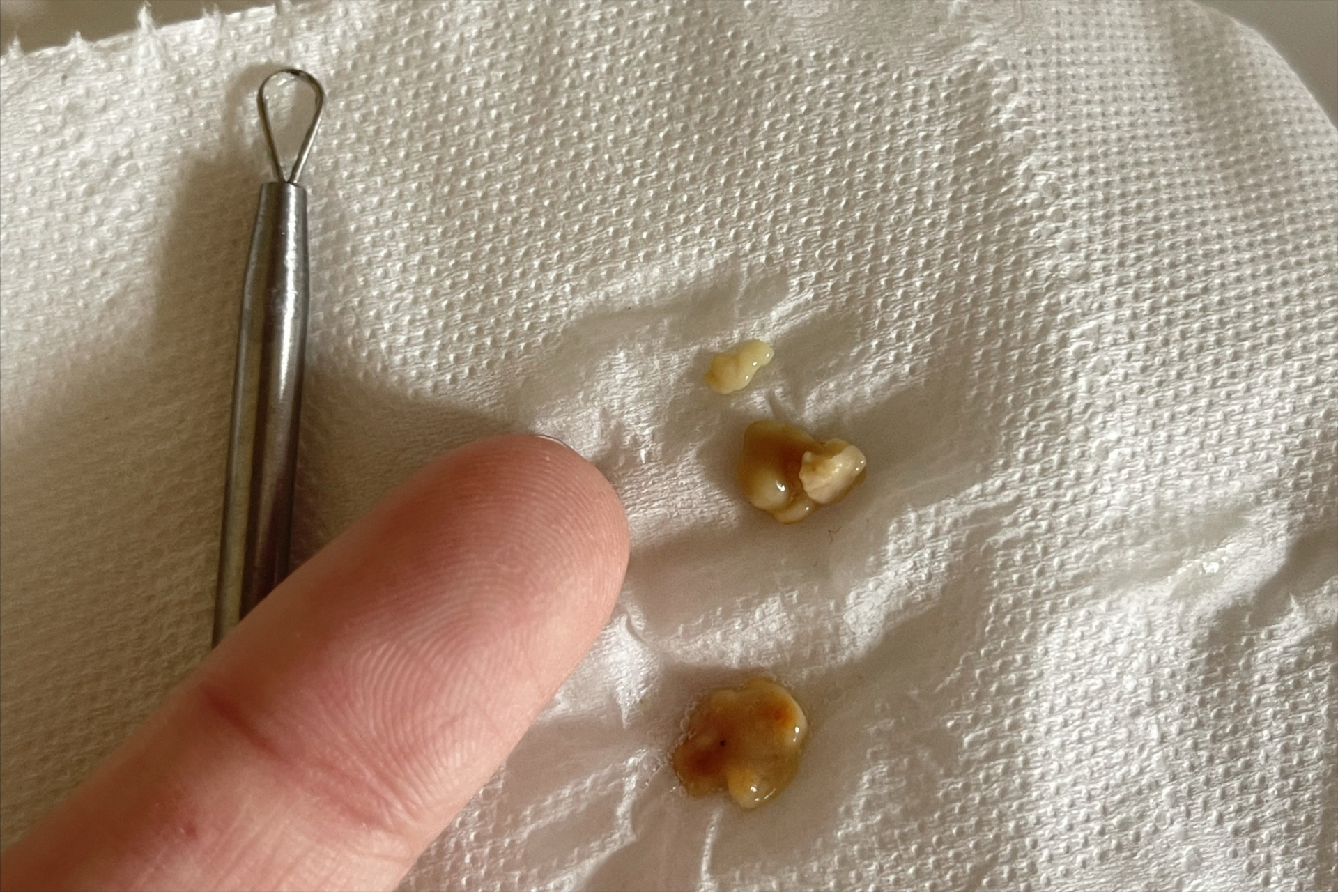 下巴长了个硬包,按压很痛