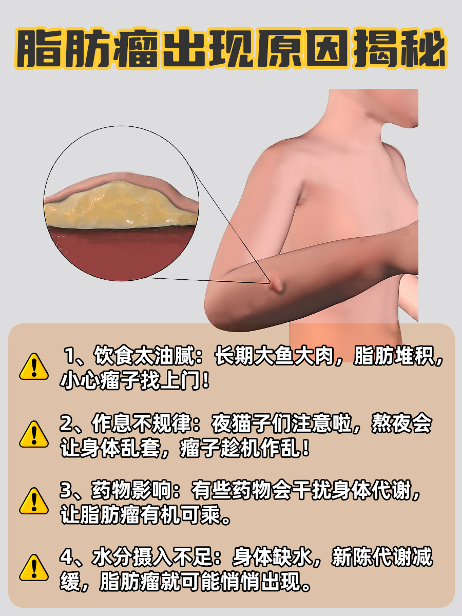 怎样确定是不是脂肪瘤?