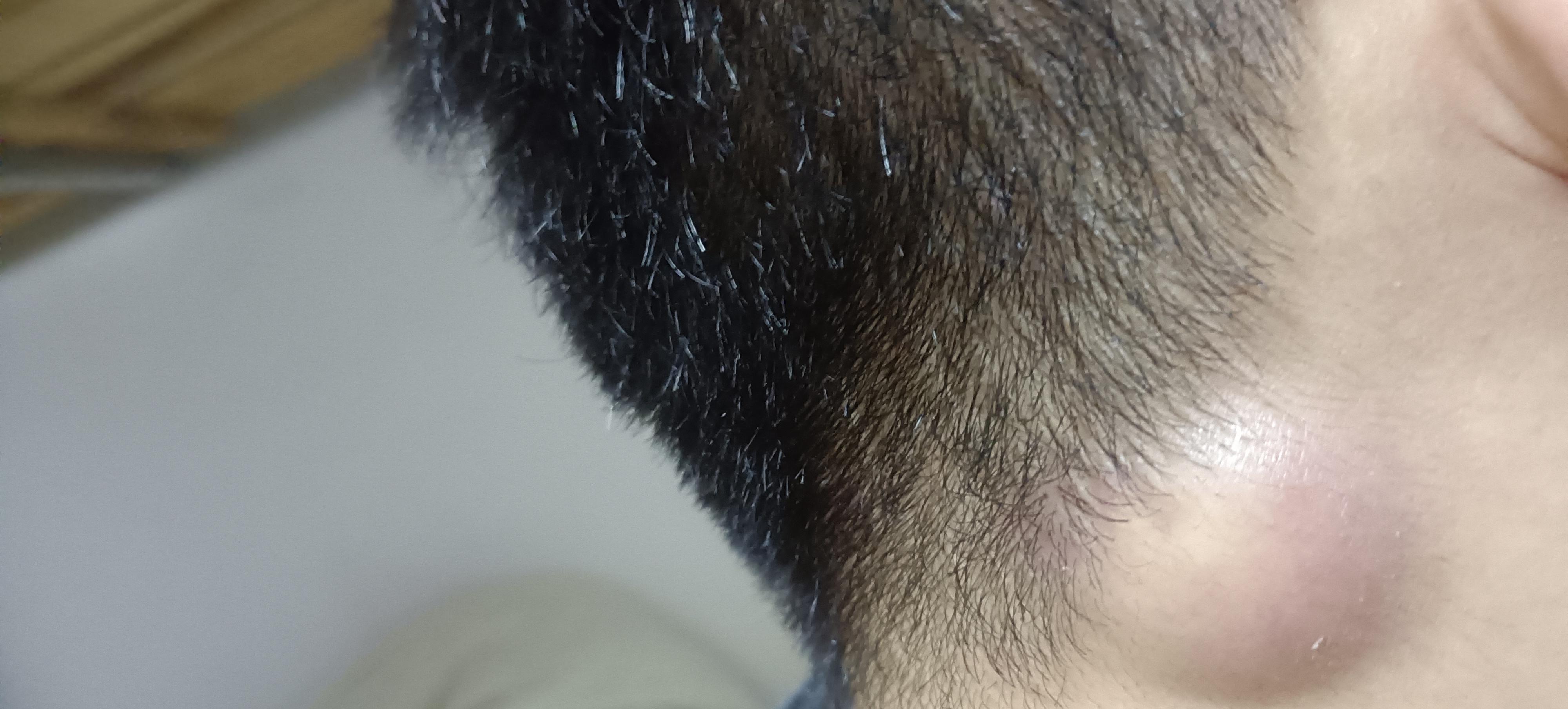 脖子后面长了一个硬包