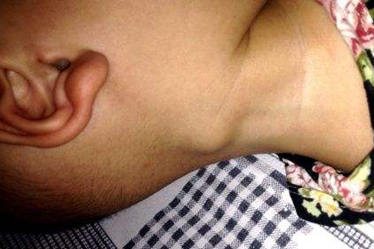 颈部淋巴癌早期症状有哪些