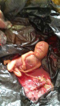 四个月能引产吗