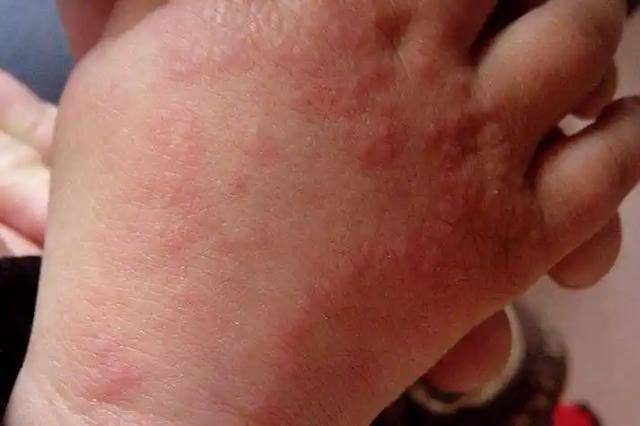 身上有红色的斑块怎么回事