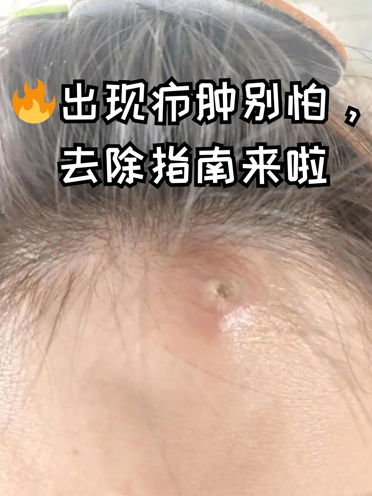 头上撞了个包,怎么消肿肿