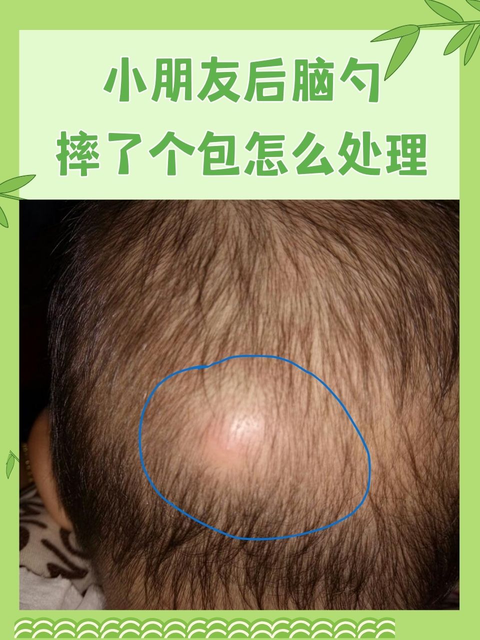 头上撞了个包,怎么消肿肿