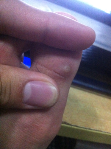 大脚趾上长了一个硬硬的疙瘩
