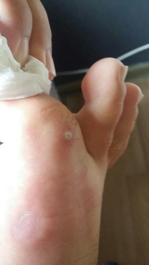 大脚趾上长了一个硬硬的疙瘩