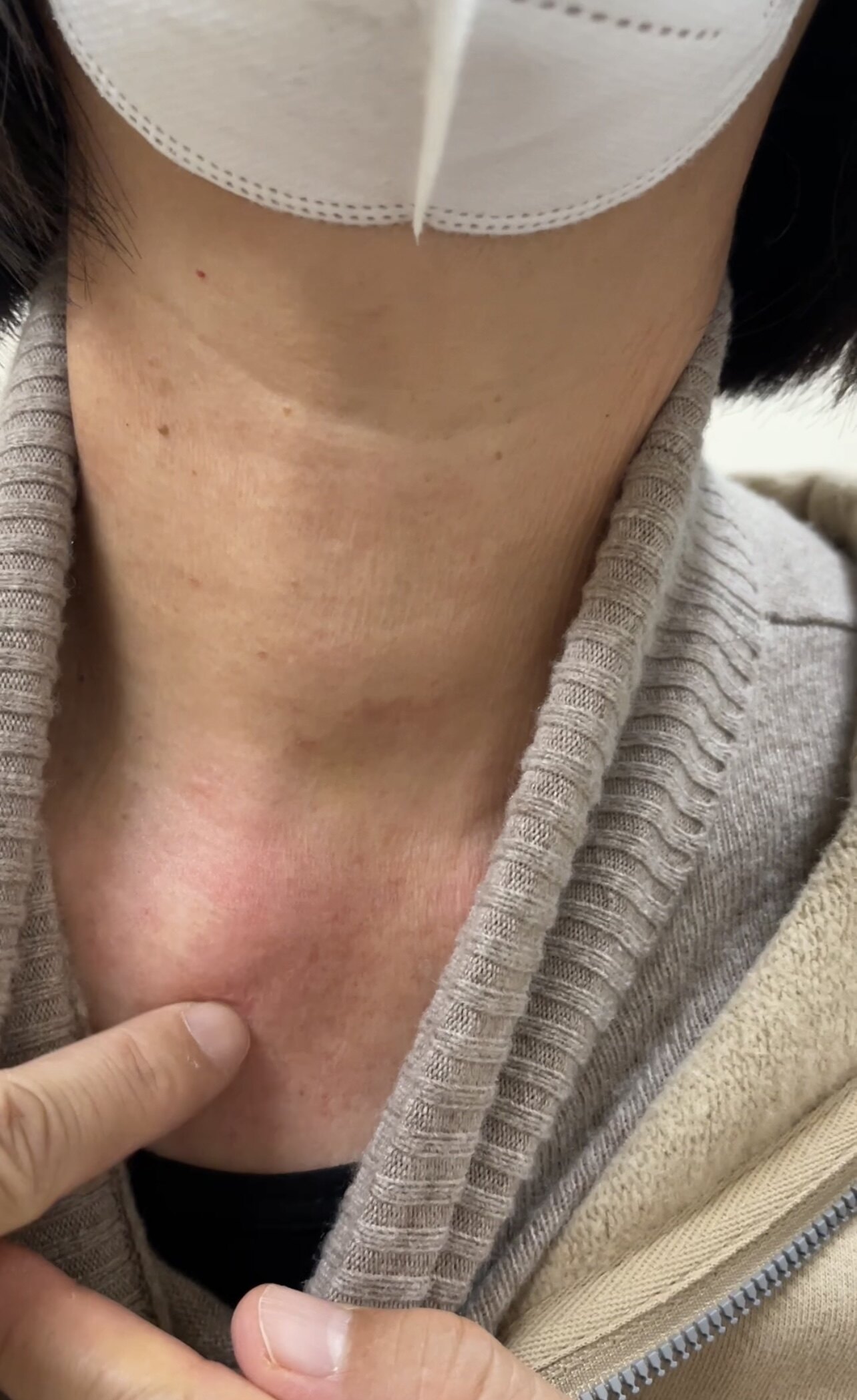 甲状腺癌什么症状