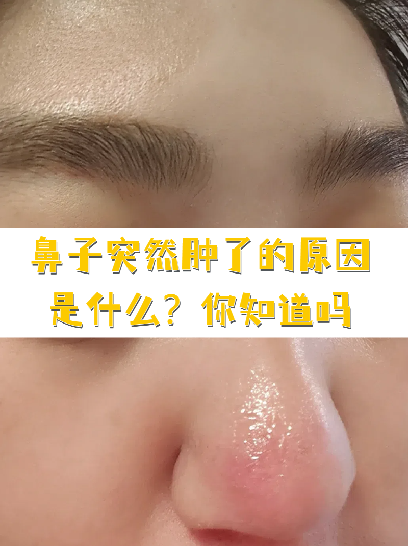 鼻子尖痒痒,是怎么回事