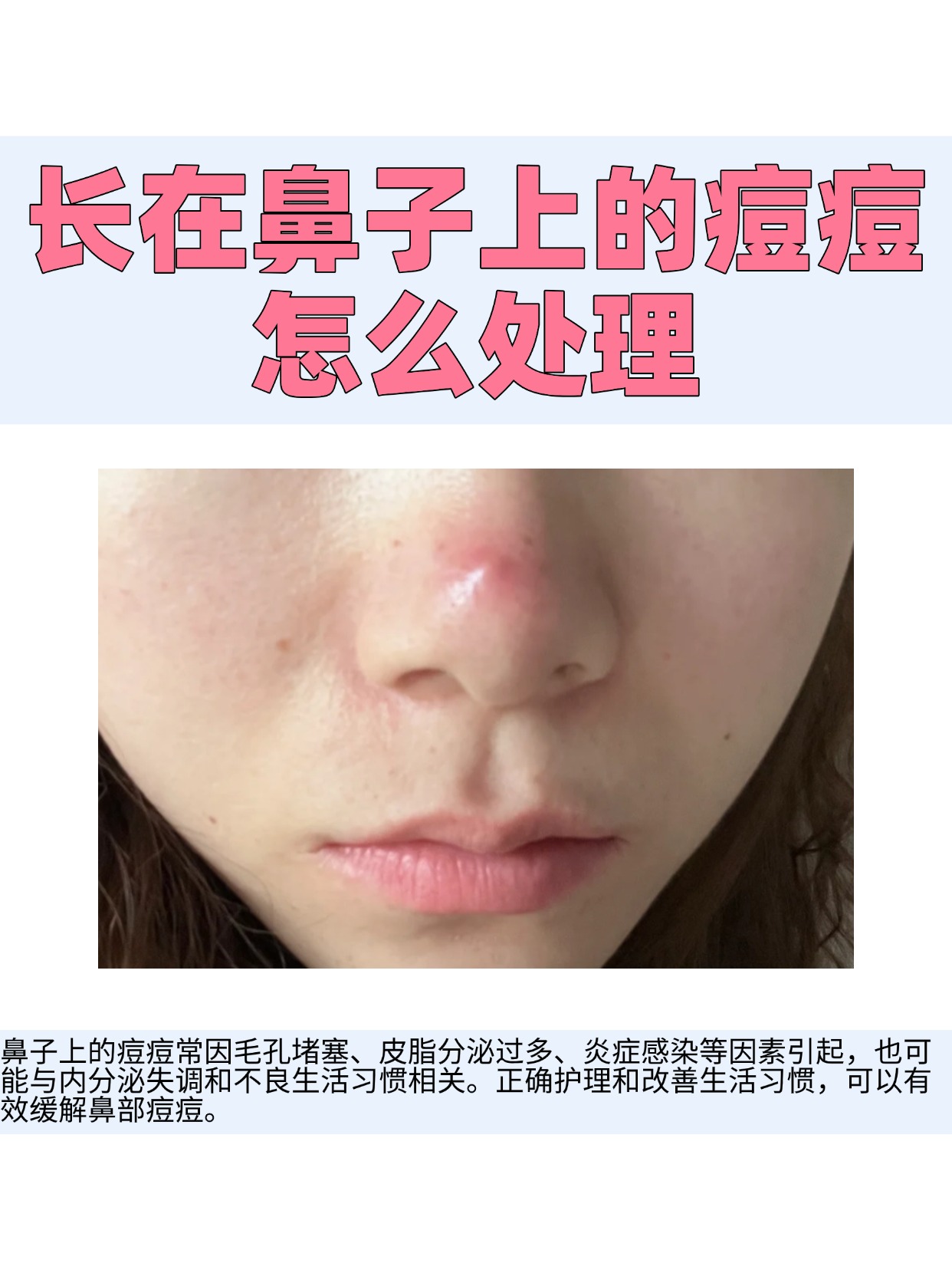 鼻子尖痒痒,是怎么回事