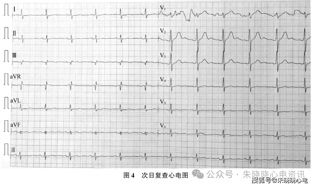 急性心肌梗塞的心电图