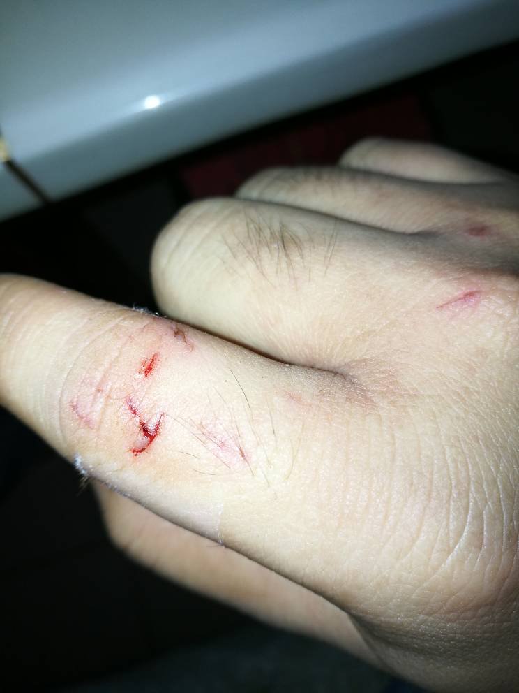 被老鼠咬出血了怎么办