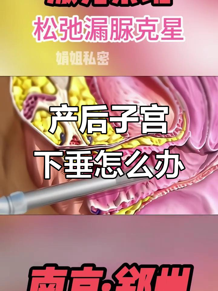 产后子宫脱垂的症状