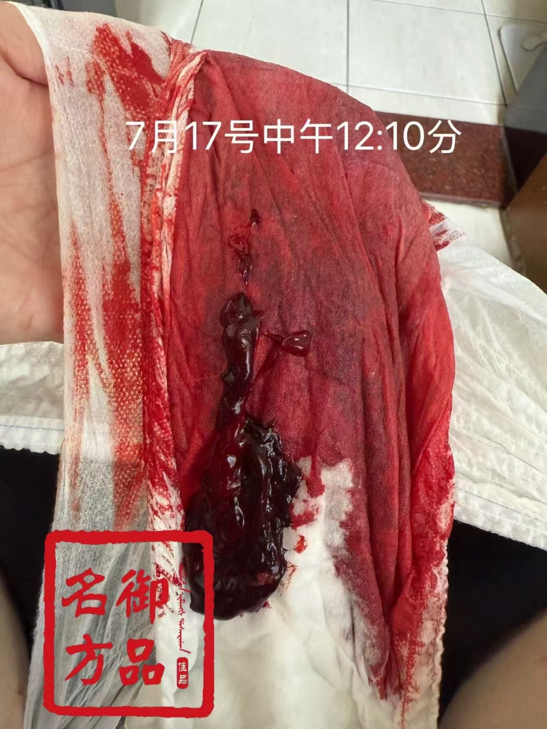 什么是产后大出血