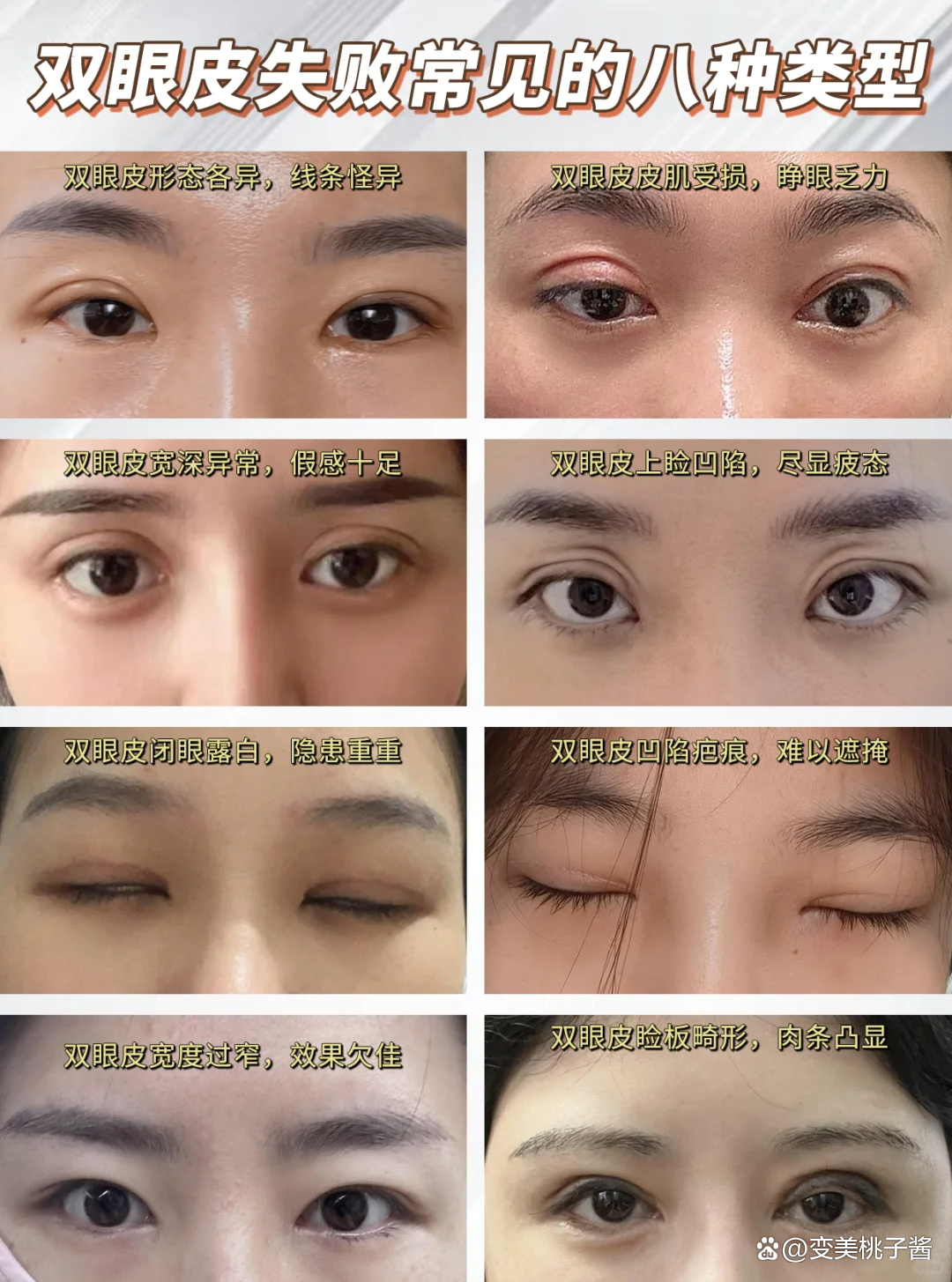 肿眼泡可以割双眼皮吗?